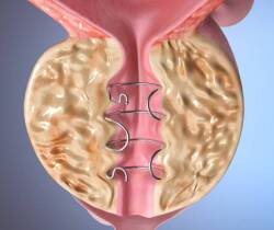 Groundbreaking Tauranga Prostate Research Could Improve Life Quality for Older Men